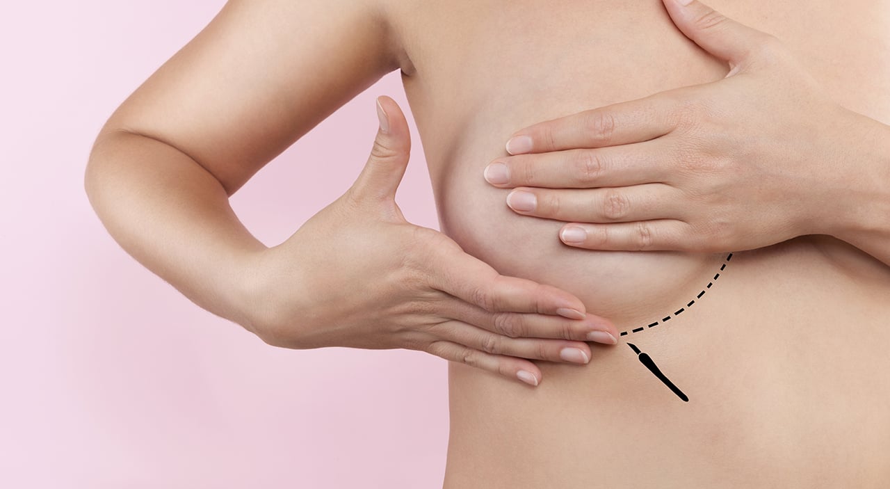 Breast Implant Incision Care at Home