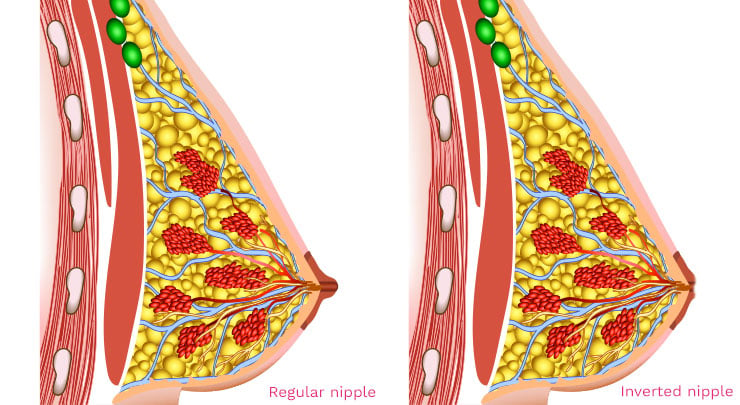 https://www.myplasticsurgeon.ca/images/inverted-nipple-and-regular-nipple-diagram.jpg