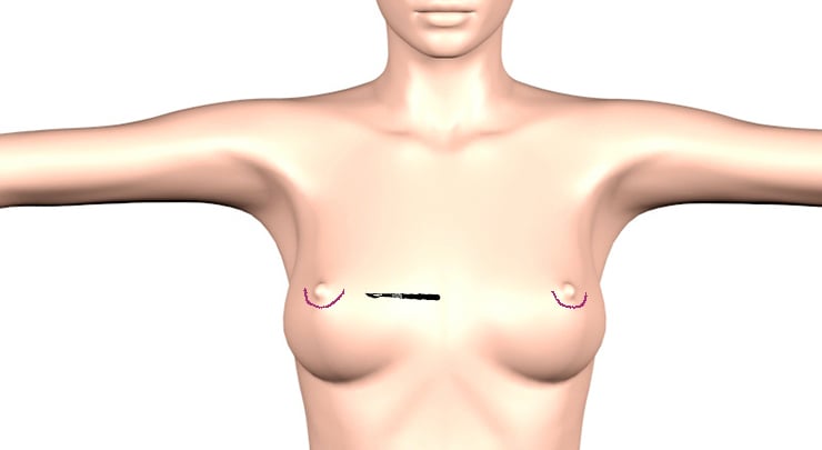 Boob Job Costs: Breast Augmentation, Lifts, and Reductions