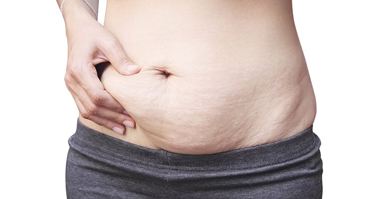 Stomach After Pregnancy 