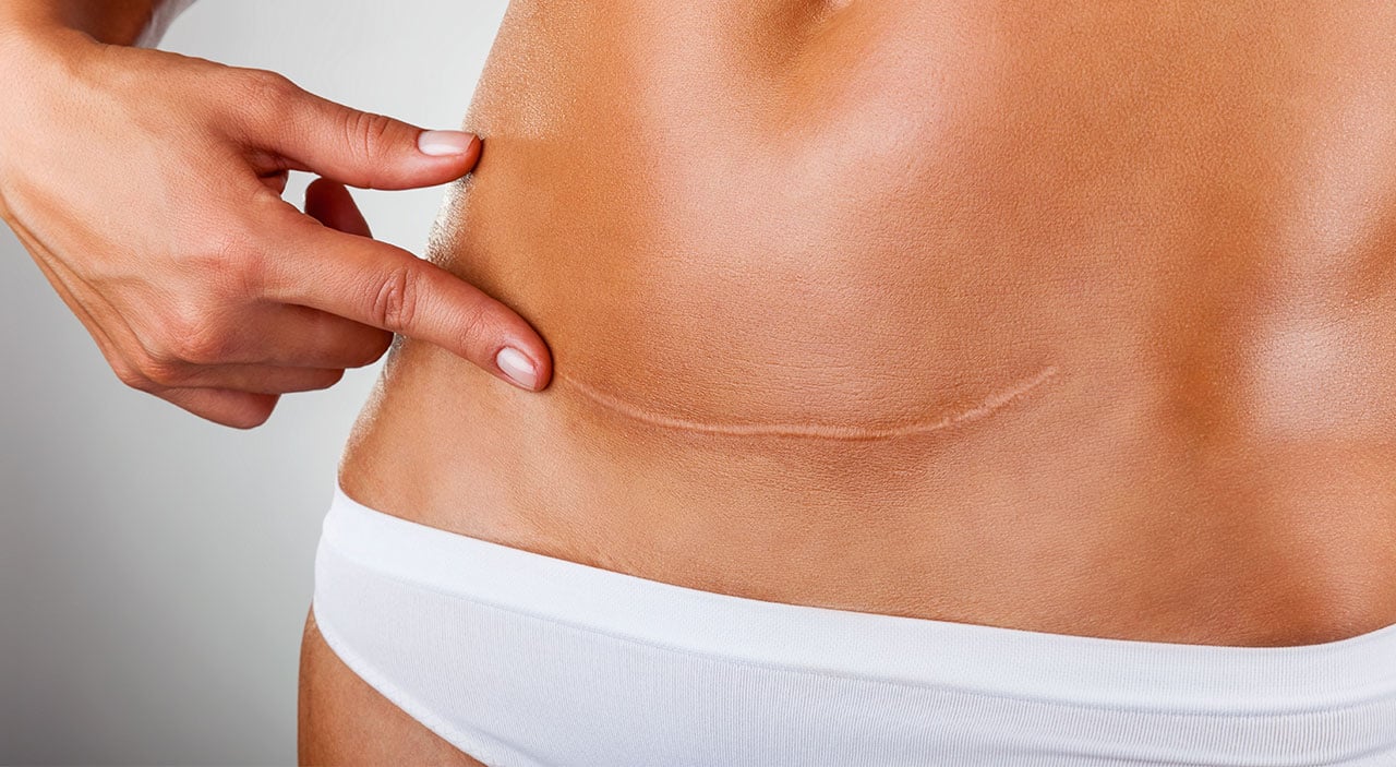 What Do Mini Tummy Tuck Scars Look Like? - Kirby Plastic Surgery