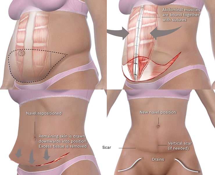 Drain Free Tummy Tuck Toronto Abdominoplasty - All Female Staff